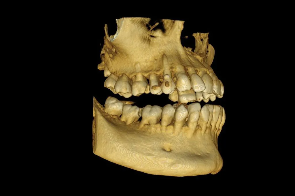 Radiología 3D - TAC dental
