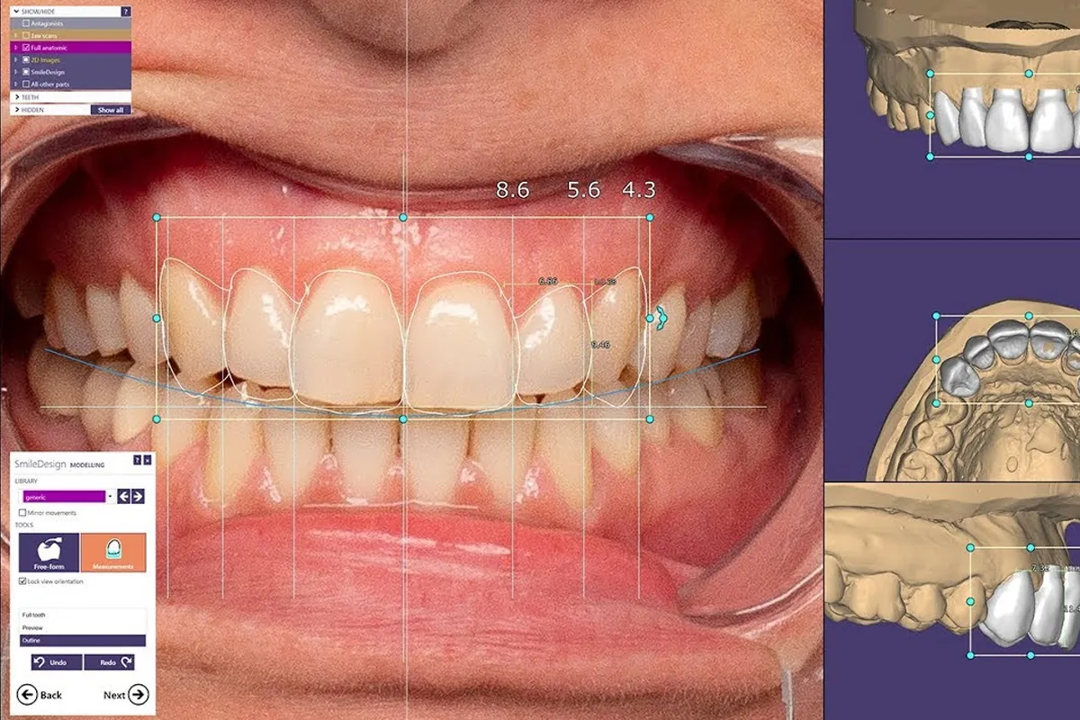 Programa de diseño de sonrisas 3D